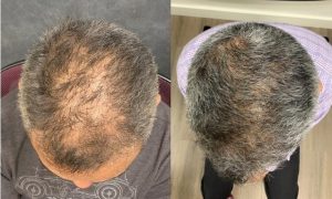 Synthetic Hair Growth Factor