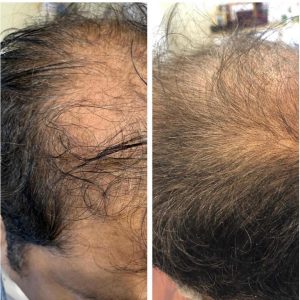 Synthetic Hair Growth Factor