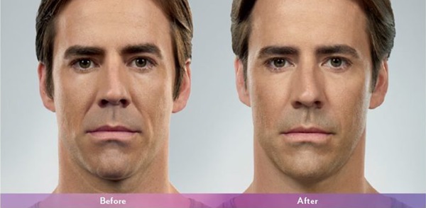 juvederm-ultra-plus-xc