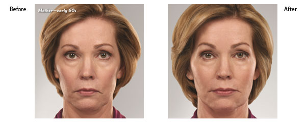 juvederm-ultra-xc