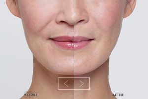 Restylane Lyft