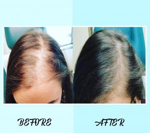 Women's Hair Growth