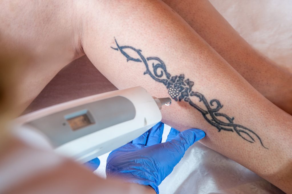 tattoo-removal